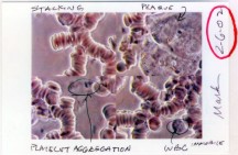 Mark Siegal Blood Before Cleanse